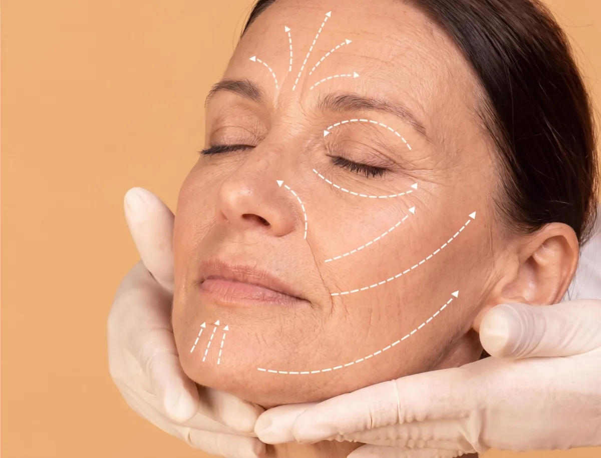 Tratamiento de Hilos Tensores en clínica estética
